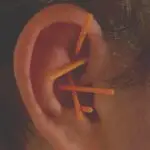 Øreakupunktur hos Indre Healing